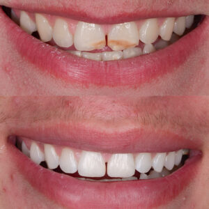 Esthétique antérieure Ultra-conservatrice - 15 janvier 2026 - Le Mans