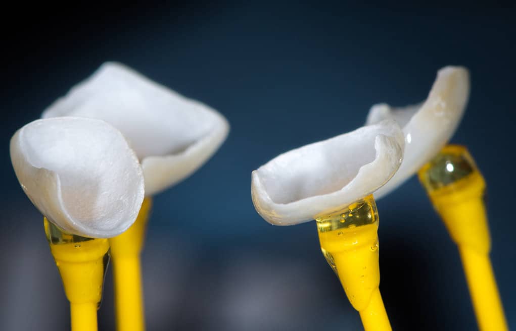 colibri-formation-dentaire-facettes-veneerlays-0