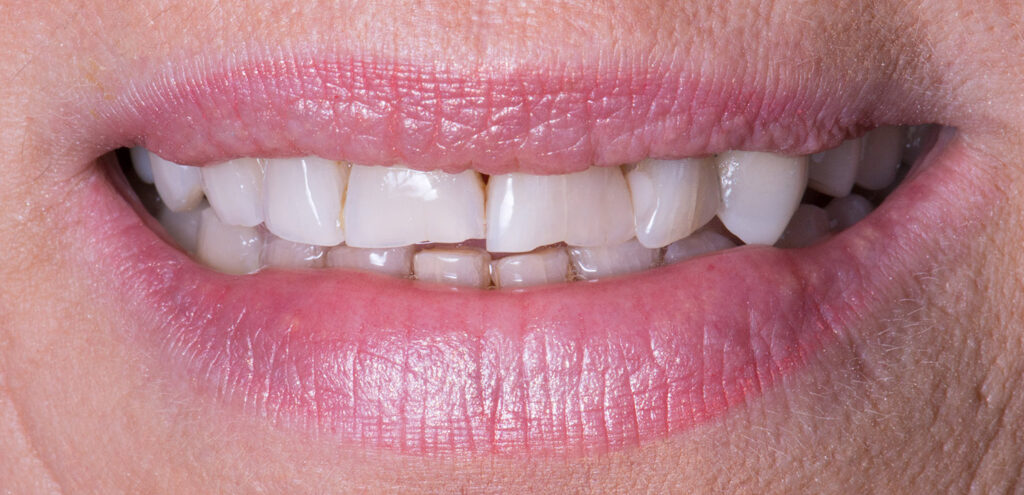 colibri-formation-dentaire-facettes-veneerlays-1