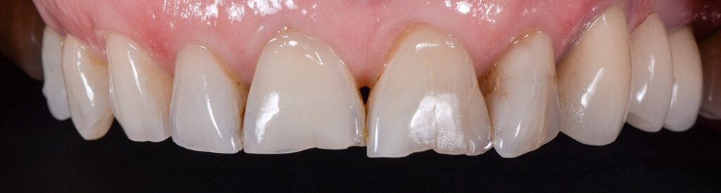 colibri-formation-dentaire-facettes-veneerlays-2