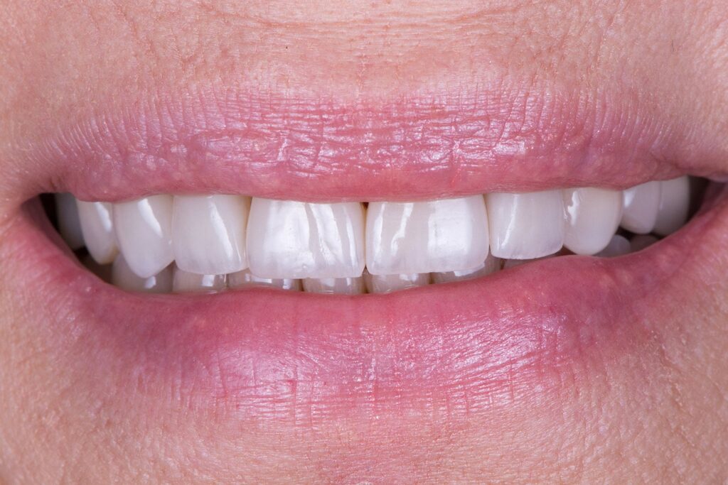 colibri-formation-dentaire-facettes-veneerlays-3