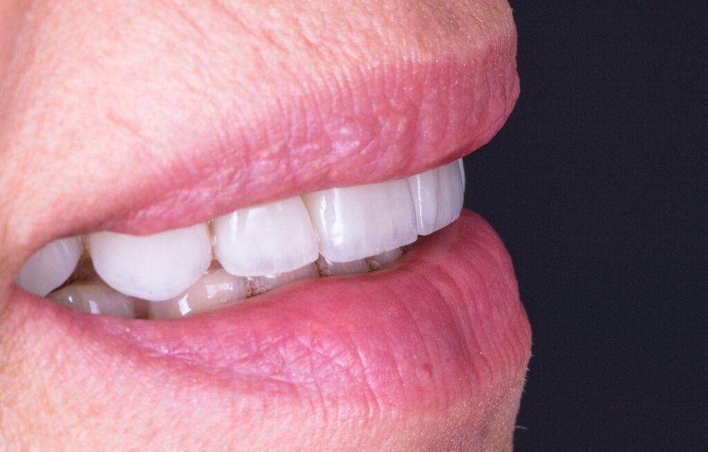 colibri-formation-dentaire-facettes-veneerlays-4