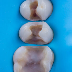 Inlays / Onlays / Overlays - 5 novembre 2026 - Le Mans